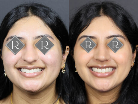 Rhinoplasty case #12571