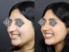 Rhinoplasty case #12571 slider thumbnail