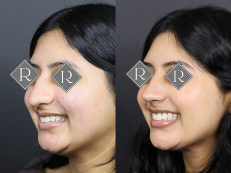 Rhinoplasty case #12571