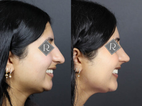 Rhinoplasty case #12571