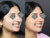 Rhinoplasty case #12571 slider thumbnail