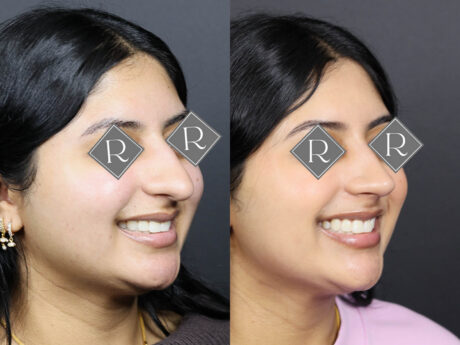 Rhinoplasty case #12571