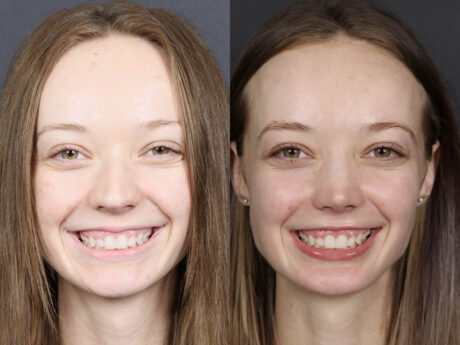 Rhinoplasty case #12578