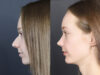 Rhinoplasty case #12578 slider thumbnail