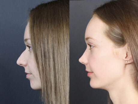 Rhinoplasty case #12578