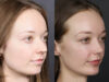 Rhinoplasty case #12578 slider thumbnail