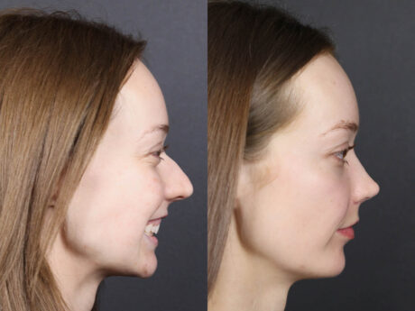 Rhinoplasty case #12578