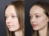 Rhinoplasty case #12578 slider thumbnail