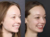 Rhinoplasty case #12578 slider thumbnail