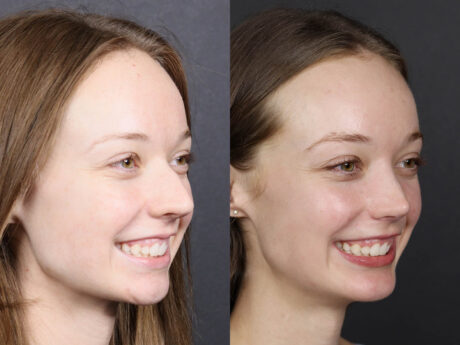Rhinoplasty case #12578