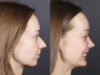 Rhinoplasty case #12578 slider thumbnail