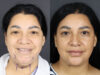Facelift case #12588 slider thumbnail