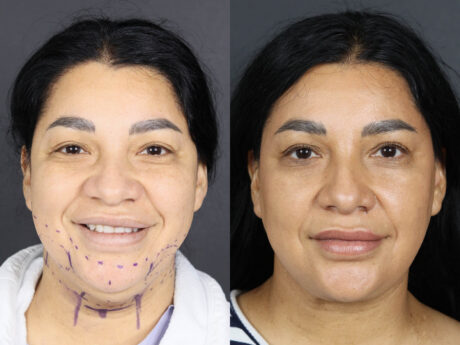 Facelift case #12588