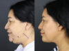 Facelift case #12588 slider thumbnail