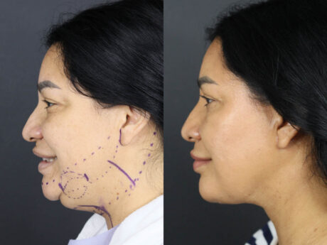 Facelift case #12588