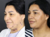 Facelift case #12588 slider thumbnail