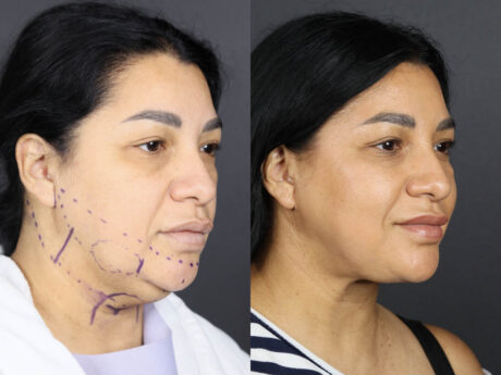 Facelift case #12588