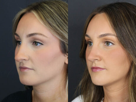 Rhinoplasty case #12594