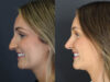 Rhinoplasty case #12594 slider thumbnail