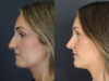 Rhinoplasty case #12594 slider thumbnail