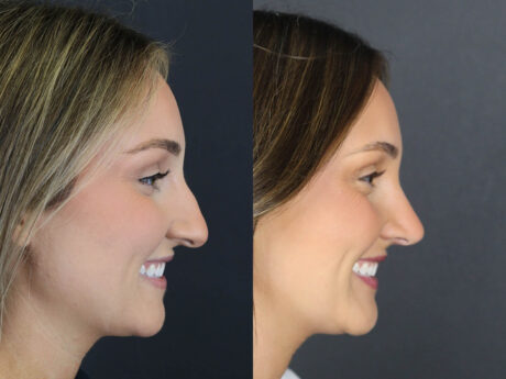 Rhinoplasty case #12594