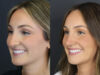 Rhinoplasty case #12594 slider thumbnail