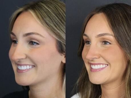 Rhinoplasty case #12594