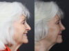 Rhinoplasty case #12601 slider thumbnail