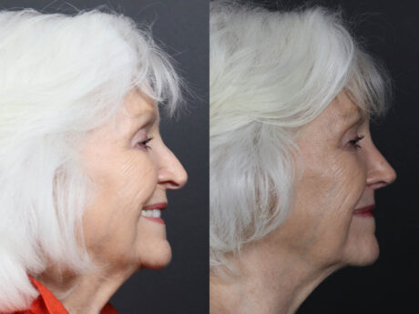 Rhinoplasty case #12601