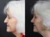 Rhinoplasty case #12601 slider thumbnail