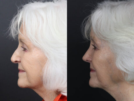 Rhinoplasty case #12601