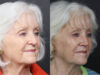 Rhinoplasty case #12601 slider thumbnail