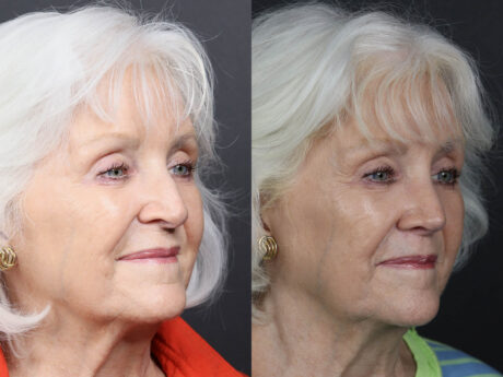 Rhinoplasty case #12601