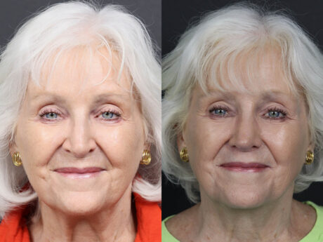 Rhinoplasty case #12601