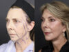 Facelift case #12608 slider thumbnail