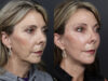 Facelift case #12608 slider thumbnail