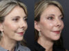 Facelift case #12608 slider thumbnail