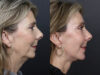 Facelift case #12608 slider thumbnail