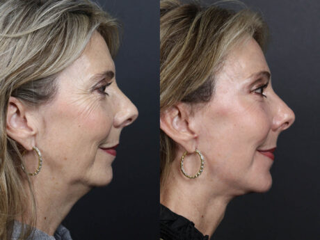 Facelift case #12608