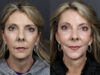 Facelift case #12608 slider thumbnail